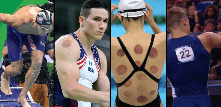 Des sportifs professionnels ont des marques rouge suite à des séances de cupping thérapie et de hijama